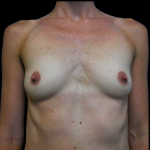 Breast Augmentation Before & After Patient #4024