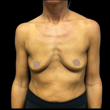 Breast Augmentation Before & After Patient #4025
