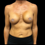 Breast Augmentation Before & After Patient #4025