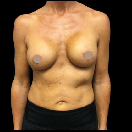 Breast Augmentation Before & After Patient #4025