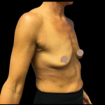 Breast Augmentation Before & After Patient #4025