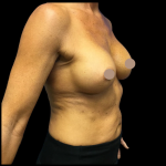 Breast Augmentation Before & After Patient #4025