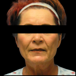 Facelift Before & After Patient #4026