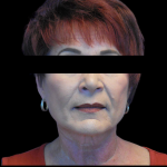 Facelift Before & After Patient #4026