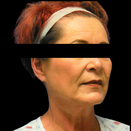 Facelift Before & After Patient #4026
