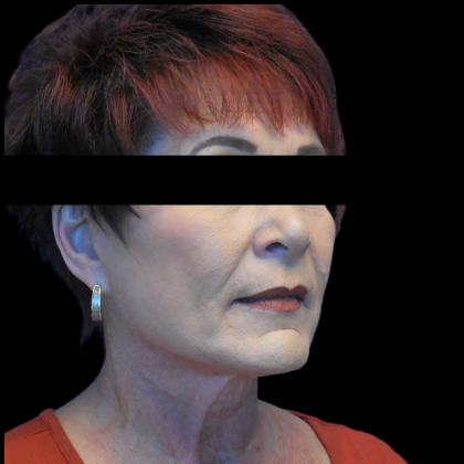 Facelift Before & After Patient #4026
