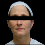 Facelift Before & After Patient #4028