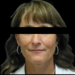Facelift Before & After Patient #4028