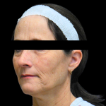 Facelift Before & After Patient #4028