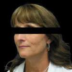 Facelift Before & After Patient #4028