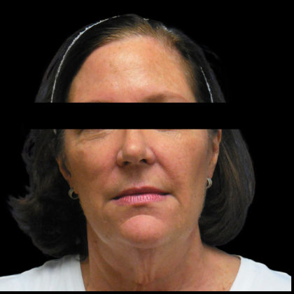 Facelift Before & After Patient #4030