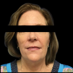 Facelift Before & After Patient #4030