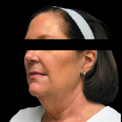 Facelift Before & After Patient #4030