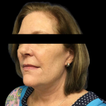 Facelift Before & After Patient #4030