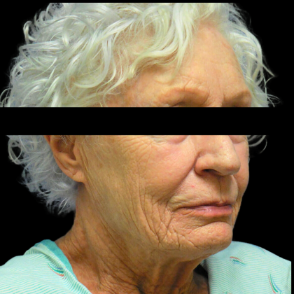 Facelift Before & After Patient #4029