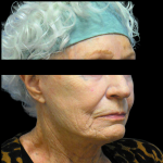Facelift Before & After Patient #4029