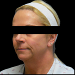 Facelift Before & After Patient #4031
