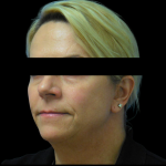 Facelift Before & After Patient #4031