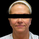 Facelift Before & After Patient #4031