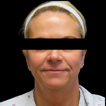 Facelift Before & After Patient #4031