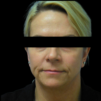 Facelift Before & After Patient #4031