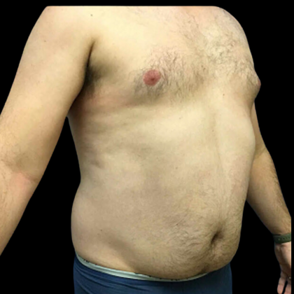 Liposuction Before & After Patient #4032