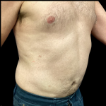 Liposuction Before & After Patient #4032
