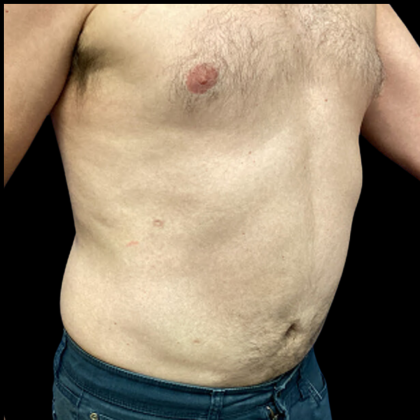 Liposuction Before & After Patient #4032