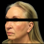 Facelift Before & After Patient #4033