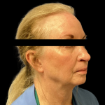 Facelift Before & After Patient #4033