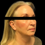 Facelift Before & After Patient #4033
