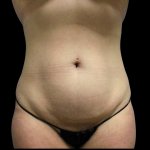 Mommy Makeover Before & After Patient #4034