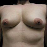 Mommy Makeover Before & After Patient #4034