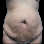 Tummy Tuck Before & After Patient #4036