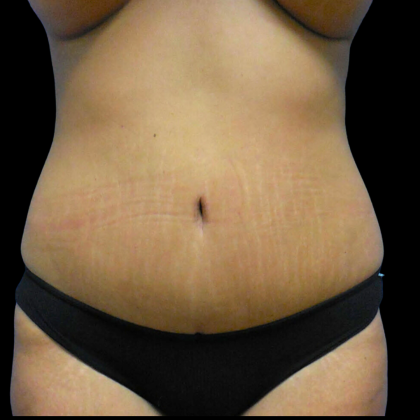 Tummy Tuck Before & After Patient #4036