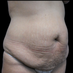 Tummy Tuck Before & After Patient #4036