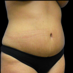 Tummy Tuck Before & After Patient #4036