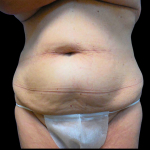 Tummy Tuck Before & After Patient #4038