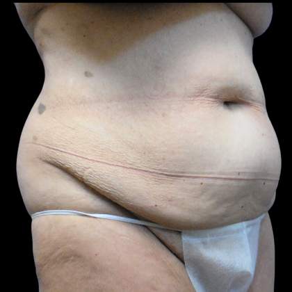 Tummy Tuck Before & After Patient #4038