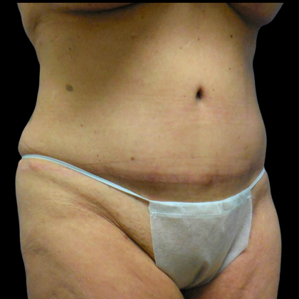 Tummy Tuck Before & After Patient #4038