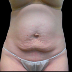 Tummy Tuck Before & After Patient #4075