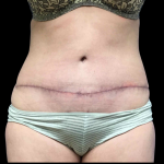 Tummy Tuck Before & After Patient #4075