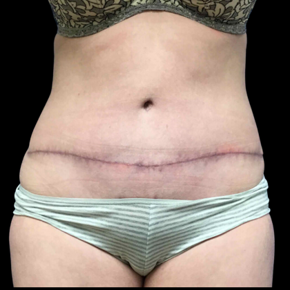 Tummy Tuck Before & After Patient #4075