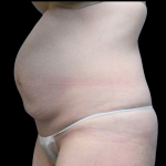 Tummy Tuck Before & After Patient #4075