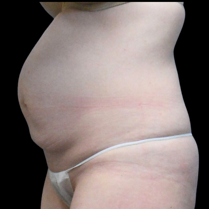 Tummy Tuck Before & After Patient #4075