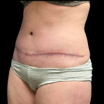 Tummy Tuck Before & After Patient #4075