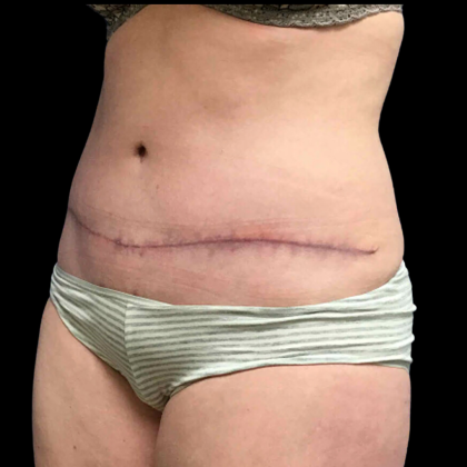 Tummy Tuck Before & After Patient #4075