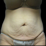 Tummy Tuck Before & After Patient #4076