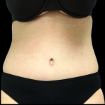 Tummy Tuck Before & After Patient #4076