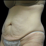 Tummy Tuck Before & After Patient #4076